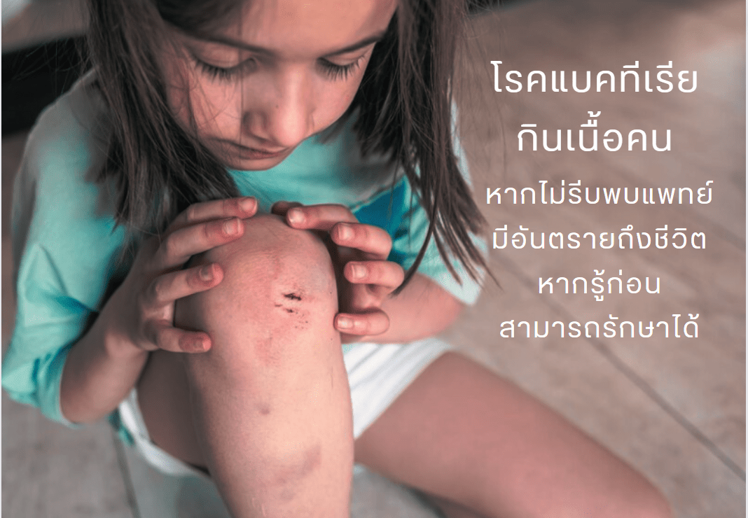 ระวังแบคทีเรียกินเนื้อ